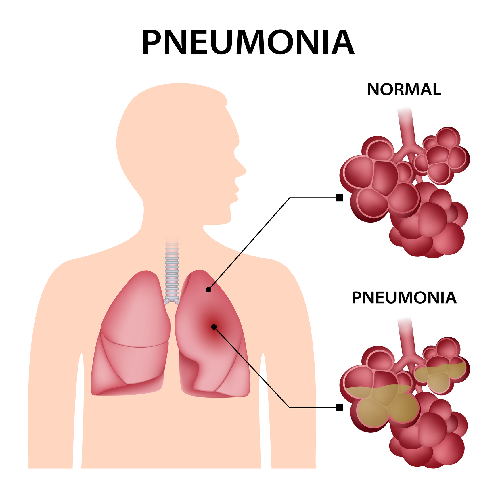 what are the symptoms of pneumonia